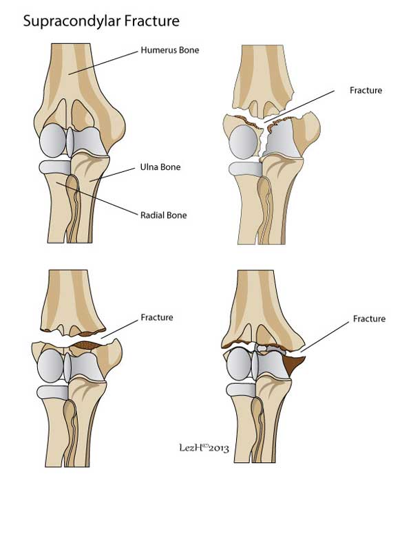 Most fractures at the elbow joint occur in children. 