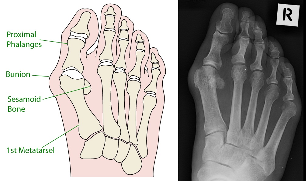 bunionectomy x ray