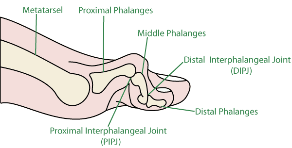 Hammer Toes - Orthoanswer