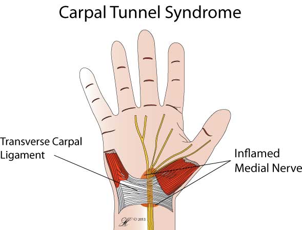 Carpal Tunnel Syndrome - Orthoanswer