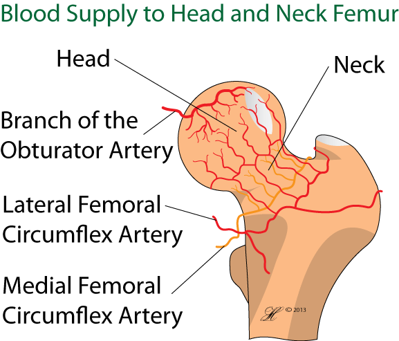 Osteonecrosis of the Hip