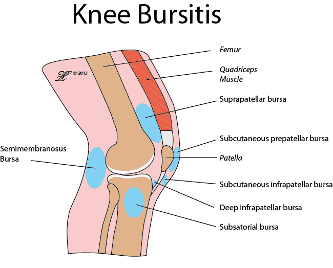 Hip Bursitis - Orthoanswer