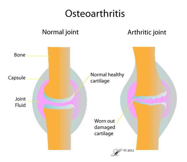 Hip Bursitis - Orthoanswer