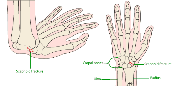 scaphoid fracture symptoms)