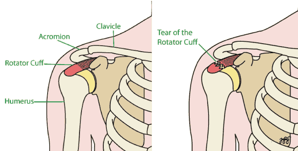 Hip Bursitis - Orthoanswer