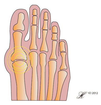 Hip Bursitis - Orthoanswer