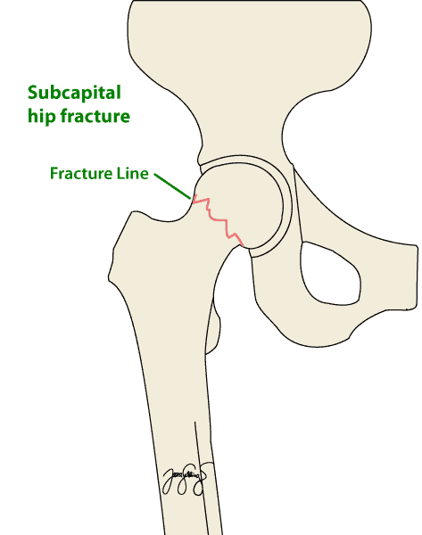 proximal femur fracture