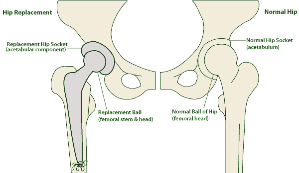 Hip Bursitis - Orthoanswer