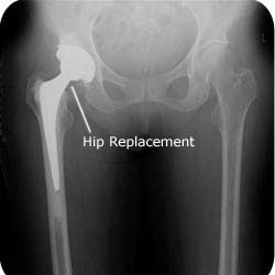 What is a Total Hip Replacement? - Orthoanswer