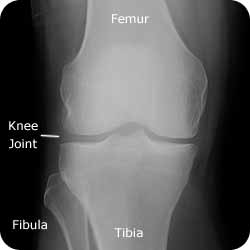 Hip Bursitis - Orthoanswer