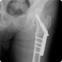 Xray of a hip fracture that has been fixed with surgical plates and screws called a DHS