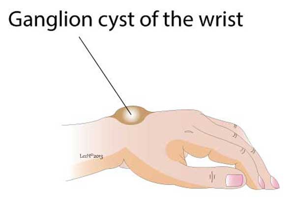 Ganglion cyst of the wrist