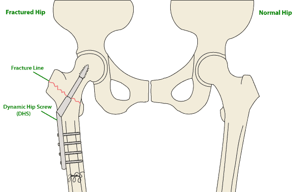 DHS hip screw