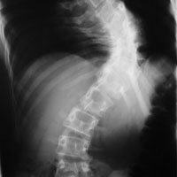 X-ray of the spine from the side showing the sideways curve of scoliosis
